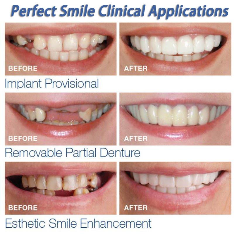 Snap on Veneers Upper and Lower 2 Pcs