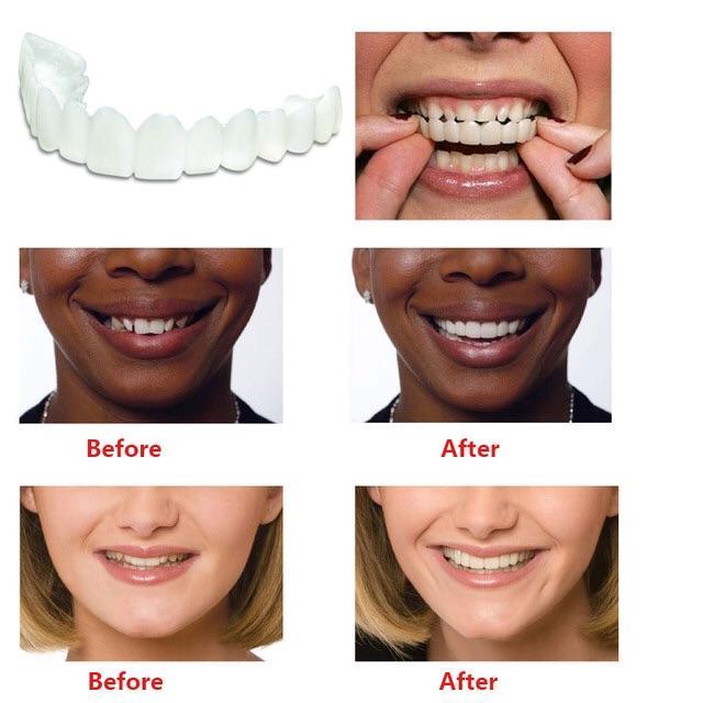 Snap on Veneers Upper and Lower 2 Pcs