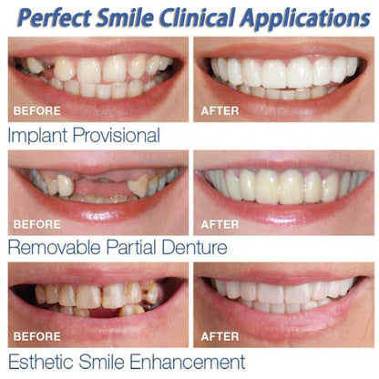 Snap on Veneers Upper and Lower 2 Pcs